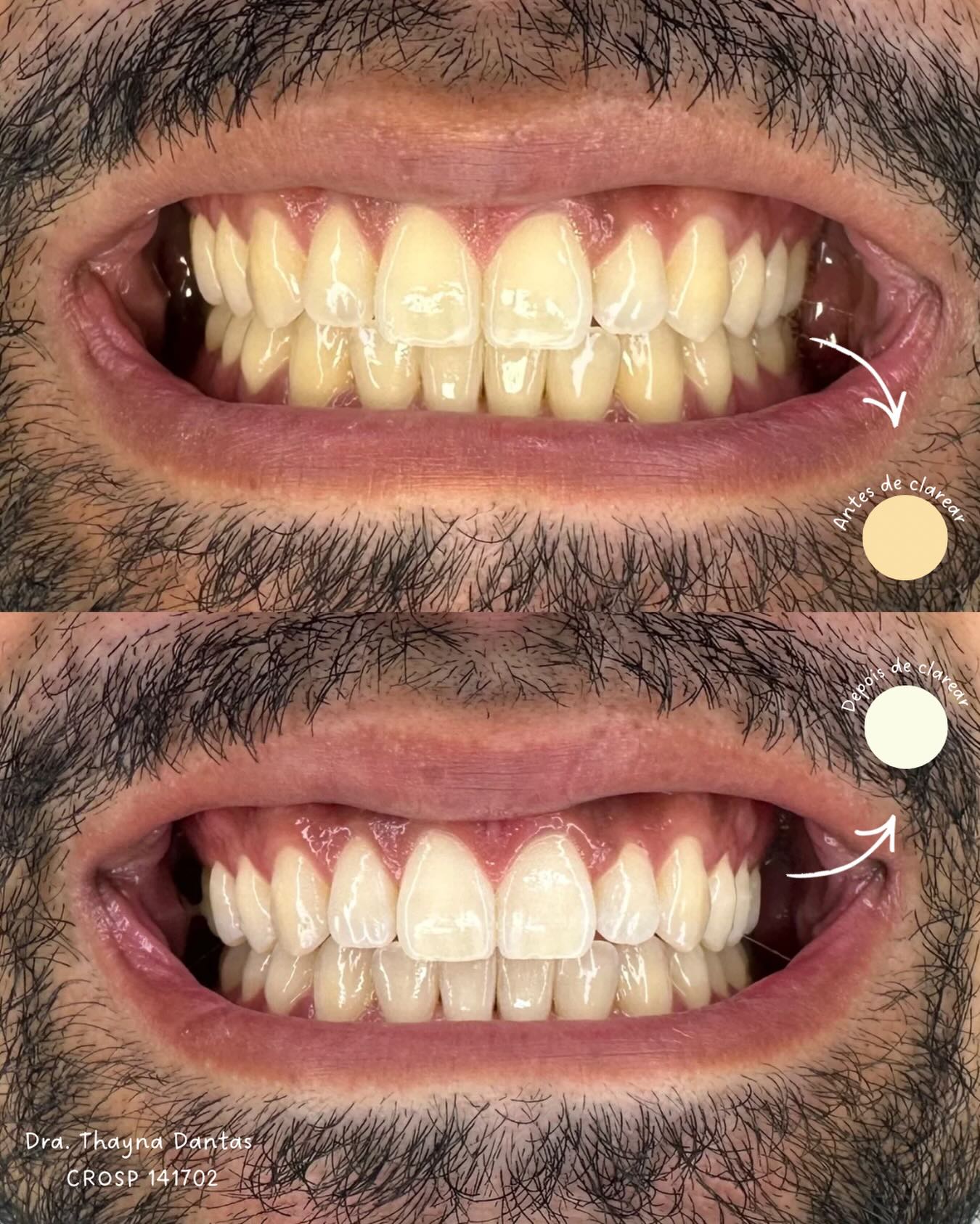 Antes e depois de clareamento dental, caso 1, Lumini Oral Clinic