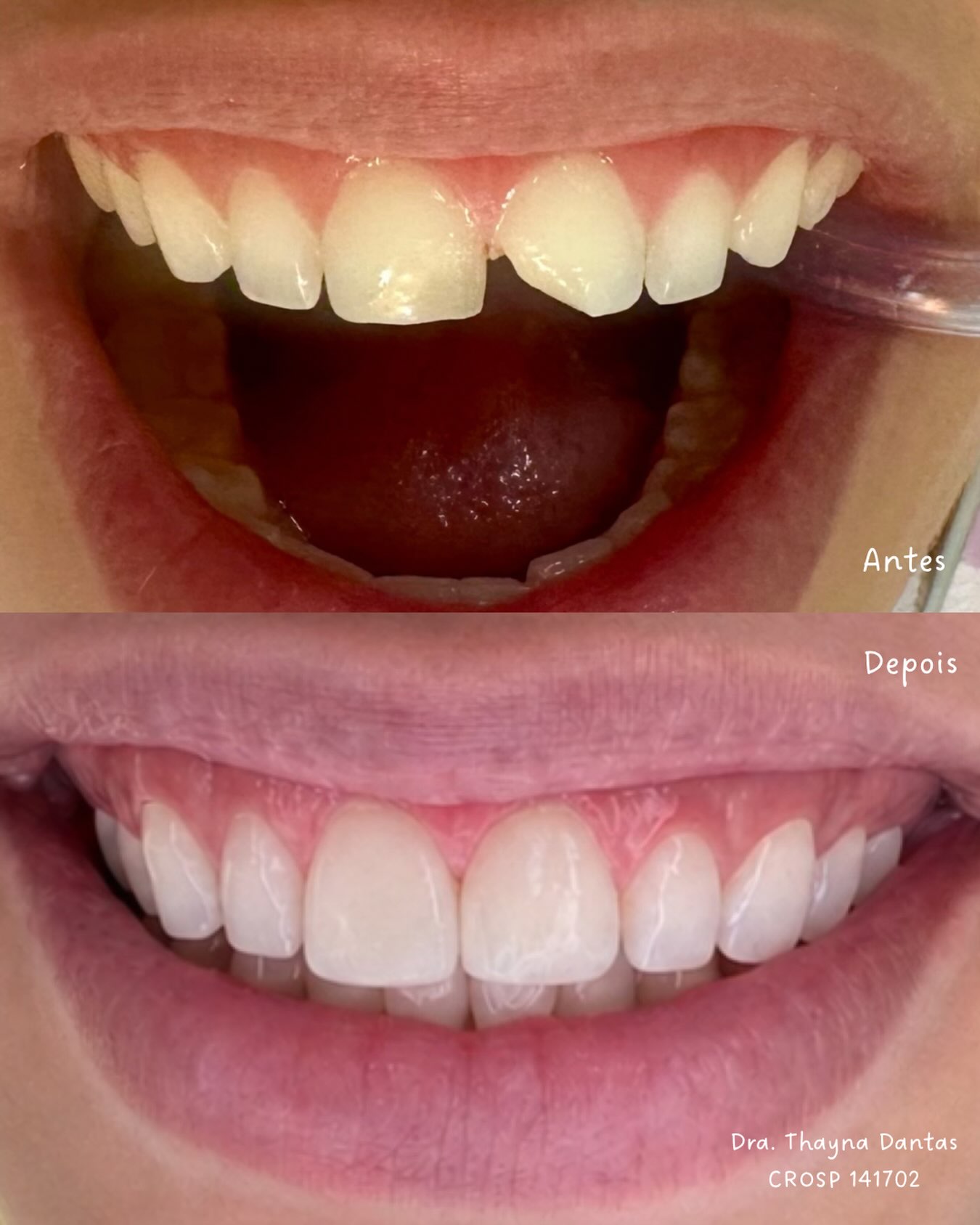 Antes e depois de clareamento dental, caso 2, Lumini Oral Clinic